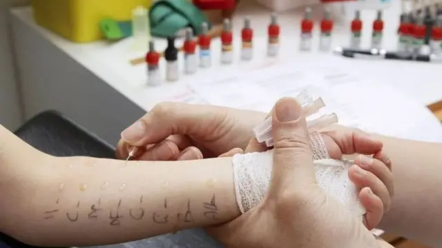 Le seul test d'allergie fondé sur des preuves actuellement disponible est celui de l'allergie aux IgE (réaction immédiate).