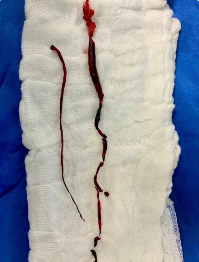 रक्ताची गाठ,