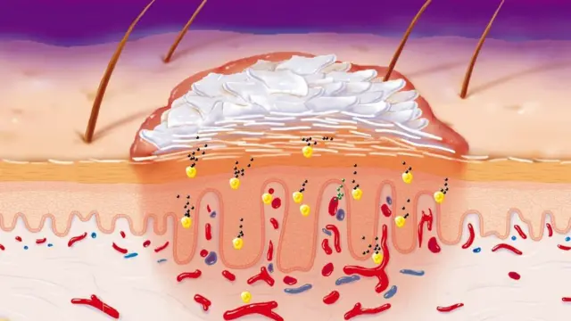 Psoriasis na-eto n'isi mmadụ
