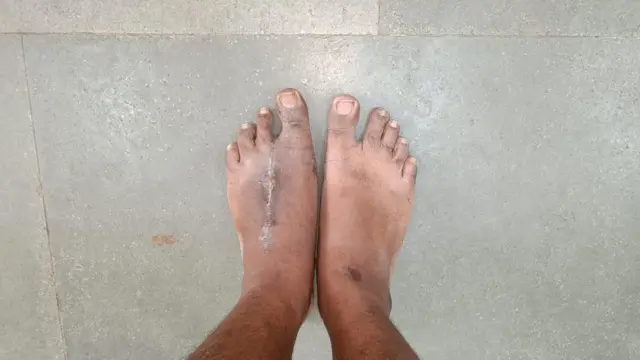 இழந்தது கட்டை விரலை, கிடைத்தது கால் விரல்