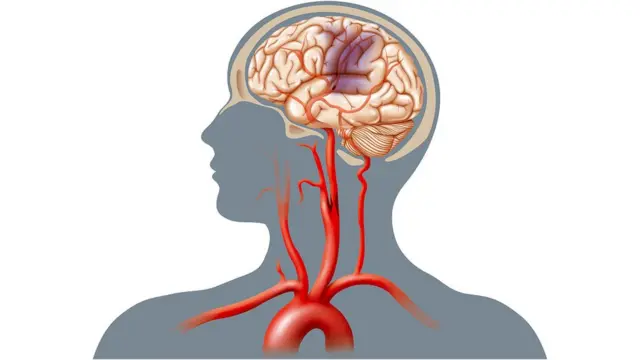 স্বাস্থ্যসম্মত খাবার, ব্যায়াম, ধূমপান ত্যাগ এবং পর্যাপ্ত পরিমাণে ঘুম স্ট্রোকের ঝুঁকি কমাতে সাহায্য করে।
