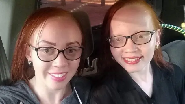 Grace Nzomo na dadake Martha nzomo wote walizaliwa wakiwa na ulemavu wa ngozi