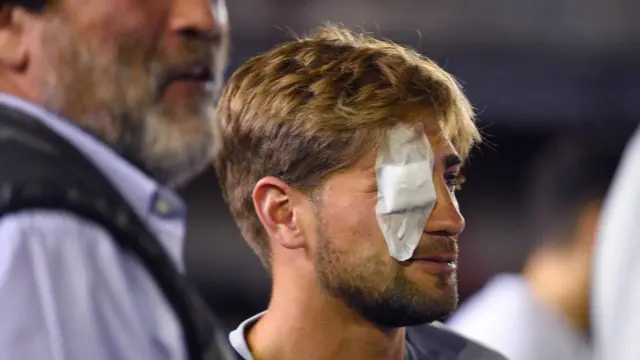 Gonzalo Lamardo con un parche en el ojo.