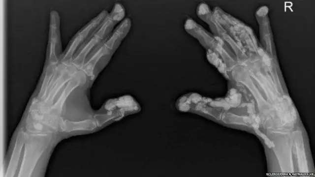 how joints gets affected with scleroderma