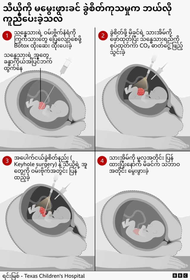မမွေးဖွားမီ သန္ဓေသားခွဲစိတ်ကုသမှု အဆင့်လေးဆင့်ကို ဖော်ပြထားတဲ့ အင်ဖိုဂရပ်ဖစ်။ 