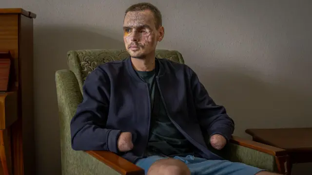 Nazar Bokhii está sentado en una silla verde con una chaqueta azul oscuro y pantalones cortos azul claro, su rostro marcado por una explosión.