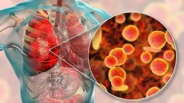 બીબીસી ગુજરાતી, એચએમપી વાઇરસ, રોગ, મેડિકલ, આરોગ્ય, સ્વાસ્થ્ય, ગુજરાત