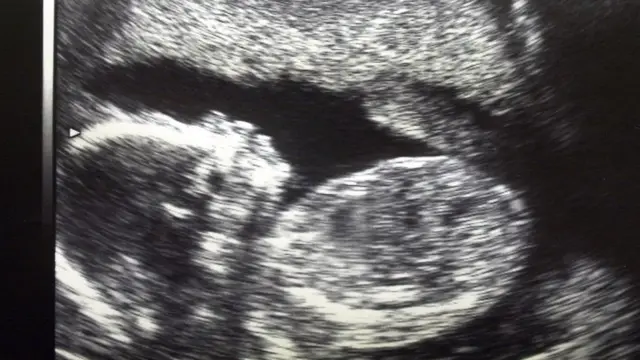 Mtoto wa kwanza alizaliwa kupitia mfumo wa upandikizaji wa mfuko wa uzazi nchini Sweden mwaka 2014