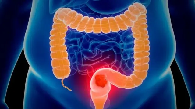 Uchunguzi wa mfumo wa usagaji chakula unaweza kugundua saratani ya utumbo mkubwa au uharibifu wa mishipa ya damu.