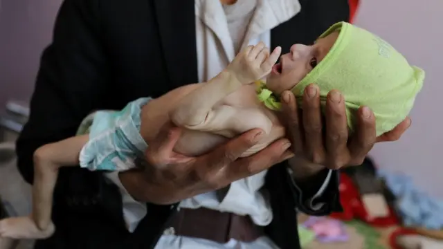 طفل يعاني من سوء التغذية
