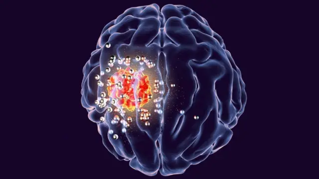 د نانو ذرو په مټ د ماغزو پر تومور برید