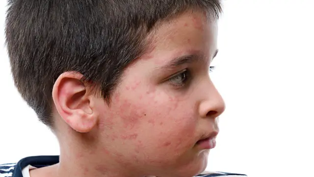 गोवर किंवा रुबेलाची लक्षणं