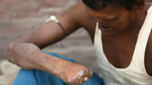 د لېپروسي يا جذام ناروغي