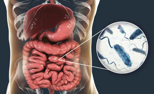 الكوليرا: ماذا نعرف عن المرض؟ وكيف يمكن علاجه؟ - BBC News عربي