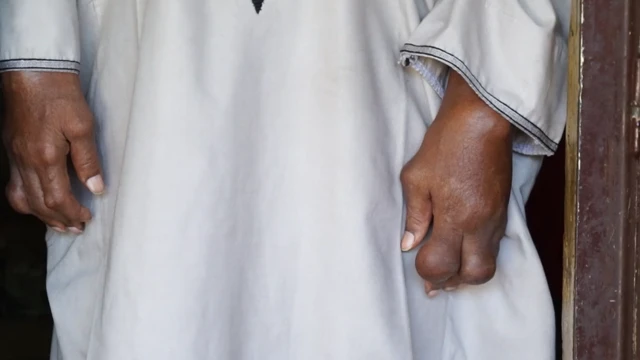 Les tophi goutteux sont des nodules sous-cutanés.