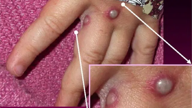 мавпяча віспа