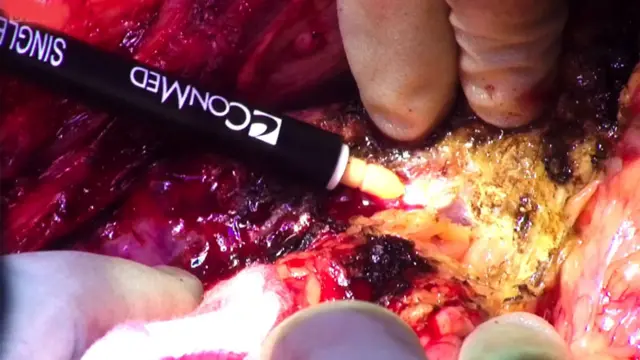 Con un lápiz electroquirúrgico empieza a separar el hígado del tejido circundante.