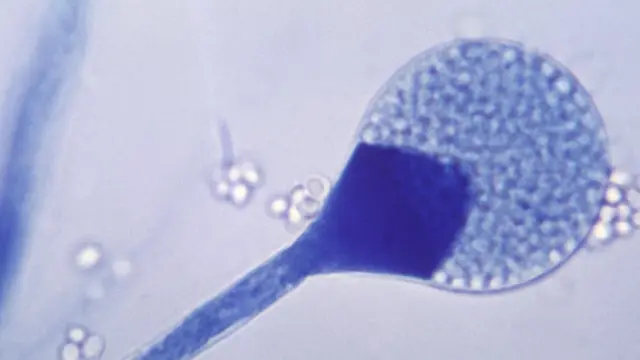 மியூகோர்மைகோசிஸ்