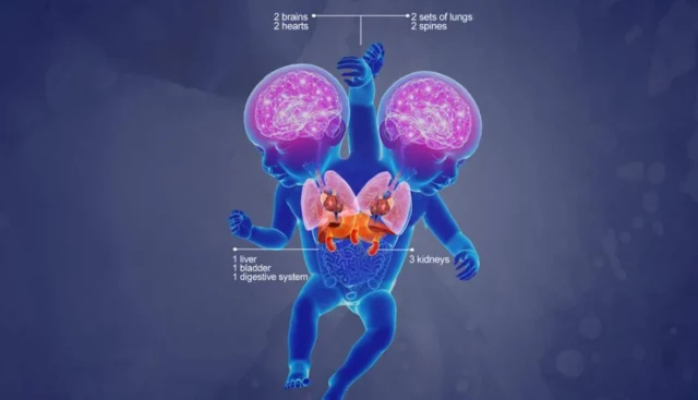 Marieme et Ndeye partagent certains organes principaux et ont également leurs propres organes distincts
