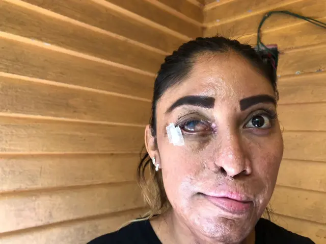 Esmeralda Millán amefanyiwa upasuaji zaidi ya mara 16 katika miaka ya hivi karibuni.