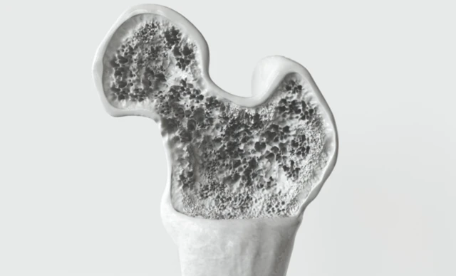 अंतराळात दीर्घकाळ राहणाऱ्या अंतराळवीरांना प्रामुख्याने हाडांच्या समस्यांचा सामना करावा लागतो. 