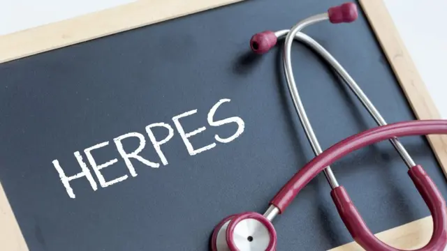 Pizarra que dice "herpes"