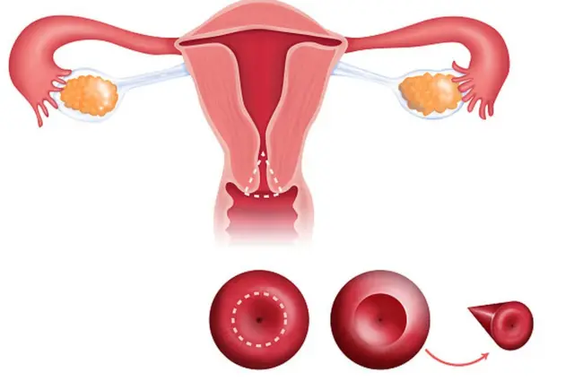 గర్భాశయ ముఖద్వార కేన్సర్‌లో ప్రధానంగా కనిపించే లక్షణం తెల్లబట్ట