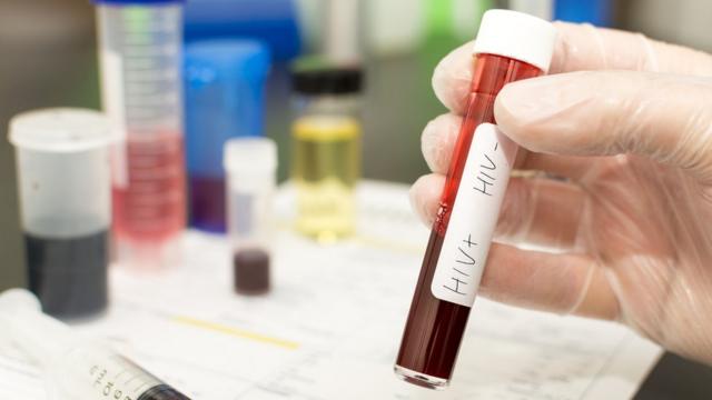 Exame de sangue vírus HIV