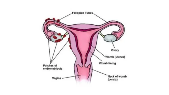 Endometriosis tumbuh di sekitar tube fallopia dan ovarium.