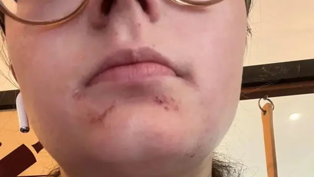 екзема, дівчина