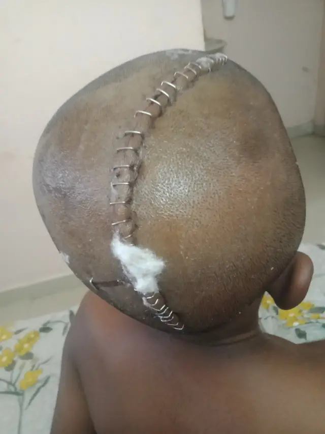 ஆசிரியர் அடித்ததால் மூளையில் அறுவை சிகிச்சை