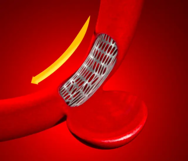 ਐਂਡੋਵੈਸਕੁਲਰ ਇਲਾਜ