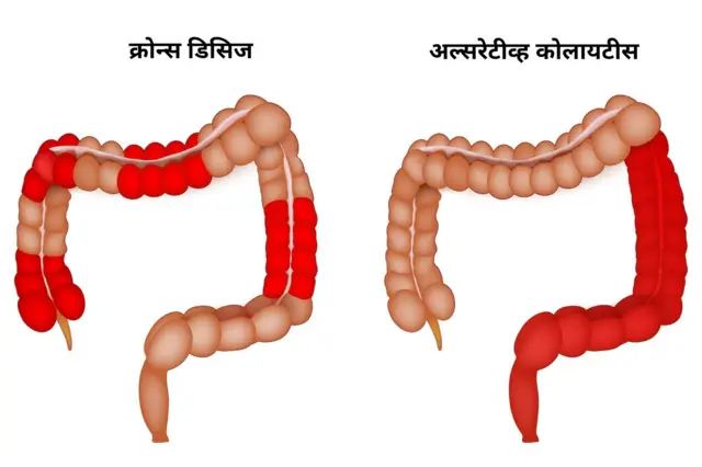क्रोन्स डिसिज (Crohn’s disease) आणि अल्सरेटीव्ह कोलायटीस (ulcerative colitis)हे इन्फ्लमेटरी बॉवेल डीसीज म्हणजे आतड्यांच्या आजाराचे सर्वाधिक आढळणारे प्रकार आहेत.