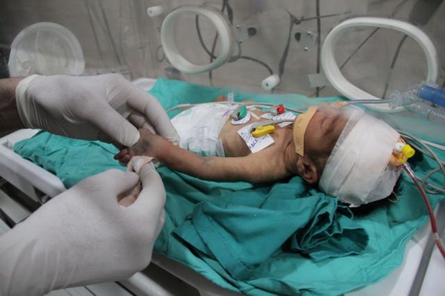 Un bebé prematuro entubado.