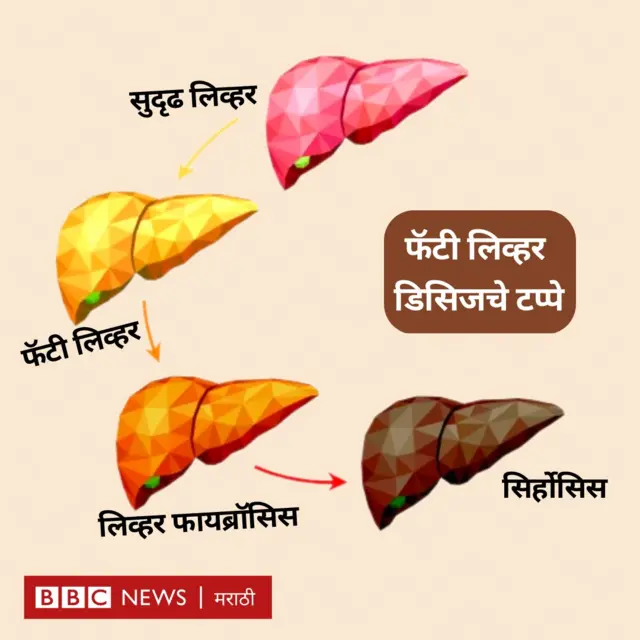 फॅटी लिव्हर 