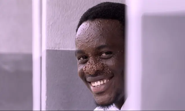 Damilare ti gba kadara nipa aisan ara rẹ, o si n ṣe ipolongo lori ayelujara lati la awọn lọyẹ nipa Trichoepithelioma