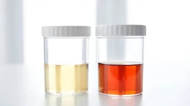 پیشاب کی رنگت