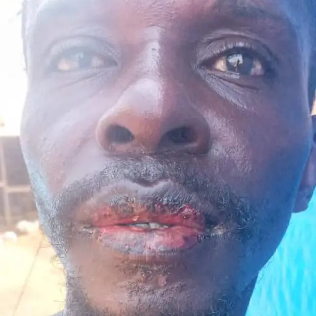 Bouche d'un pêcheur malade