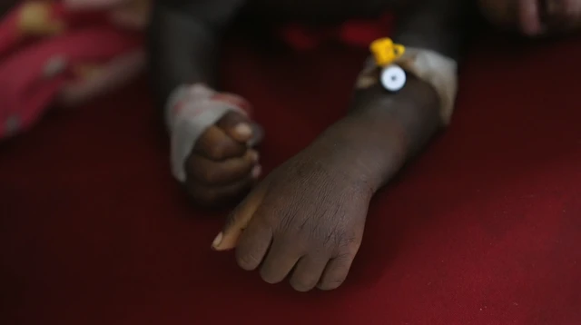 لم تستطع أن تنقذهما معا.. أم سودانية تضطر للاختيار بين علاج طفلتيها التوأم