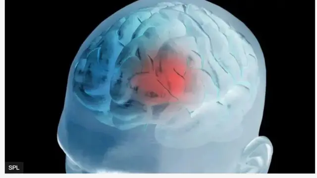 Aworan ọpọlọ ti rọparọsẹ n kọlu apa kan rẹ