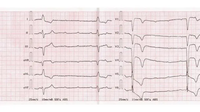 કાર્ડિયાક અરેસ્ટ