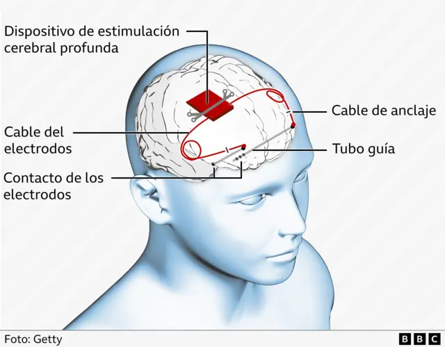 Gráfico del dispositivo cerebral