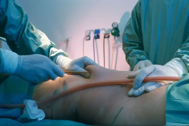 အဆီစုပ်ထုတ်ကုသမှုလုပ်နေတဲ့မြင်ကွင်းတစ်ခု (ပုံဟောင်း)