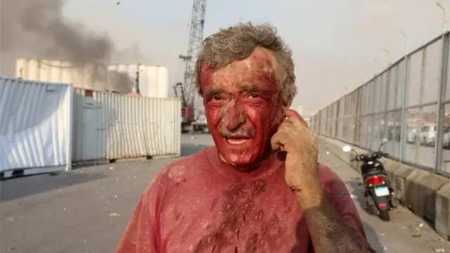 Hombre herido tras la explosión en Beirut.