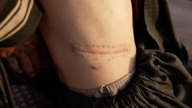 Böbreğini aldırmış biri