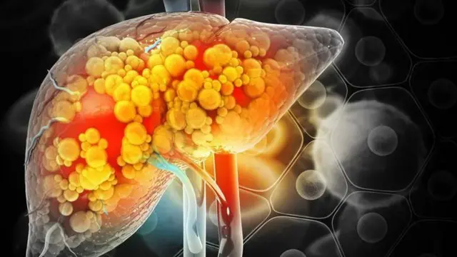 மது, கல்லீரல் நோய், மருத்துவம், உடல்நலம் 