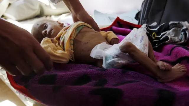 سوء التغذية في اليمن