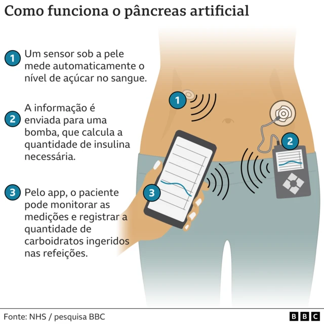 Infográfico sobre o pâncreas artificial