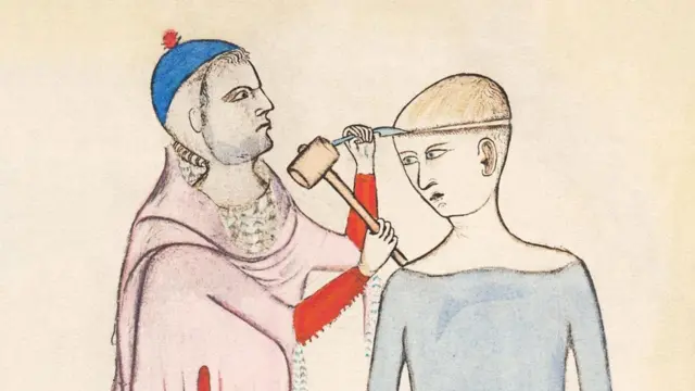 لوحة من القرن الرابع عشر للرسام غويدو دا فيغفانو تظهر عملية ثقب الجمجمة