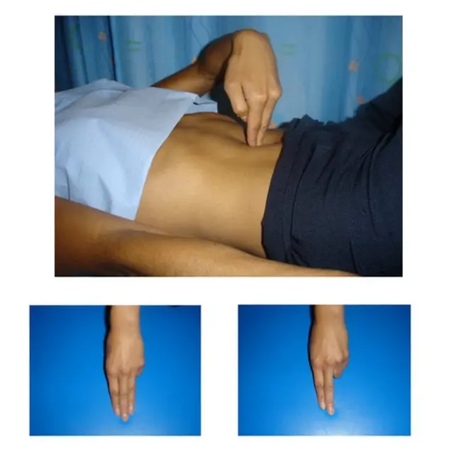 Ilustración de cómo se hace una prueba para medir la diástasis de los rectos abdominales, cortesía del departamento de Fisioterapia para la Salud de la Mujer del Hospital St. George